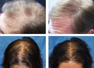 laser hair loss treatment prevention therapy worcester ma