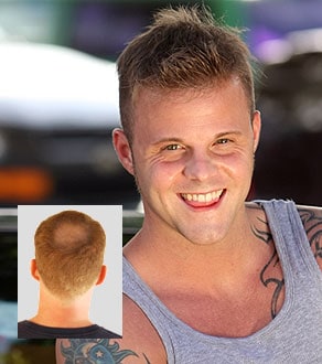 Mens hair loss replacement solutions Worcester Massachusetts