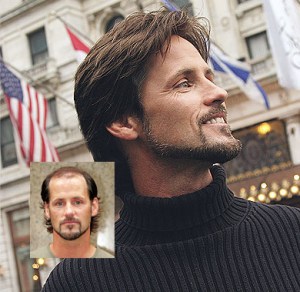 mens non-surgical hair replacement worcester massachusetts