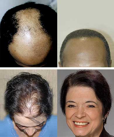 hai-restoration-solutions hair transplant doctor worcester ma