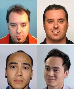 Worcester Hair Transplant