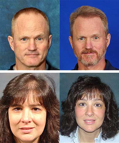 hair-transplantation-wooster-ma Worcester Hair Transplant Clinic