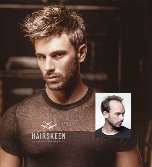 hairskeen mens hair replacement worcester massachusetts